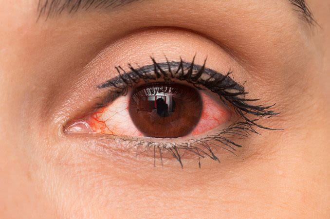 close-up of a woman with red eye condition